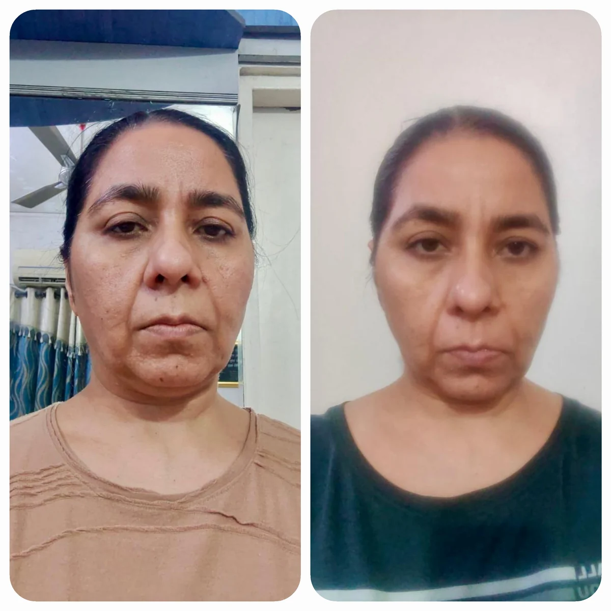 A student photographed front-on before and after a period of Face Yoga practice