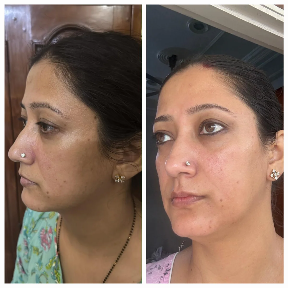 The same student in profile, before and after Face Yoga practice